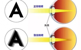 散光眼睛易疲劳怎么办，眼睛散光了怎样才能恢复